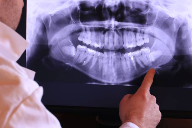 Best Emergency Treatment for Dental Infections or Abscesses in Santa Claus, IN